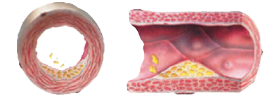 TOO MUCH FAT, SALT AND SUGAR = HIGH BLOOD PRESSURE TACHYCARDIA THROMBOSIS ATHEROSCLEROSIS (INITIAL STAGE OF ILLNESS)