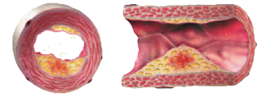 TOO MUCH FAT, SALT AND SUGAR = HIGH BLOOD PRESSURE TACHYCARDIA THROMBOSIS ATHEROSCLEROSIS (ADVANCED STAGE OF ILLNESS)