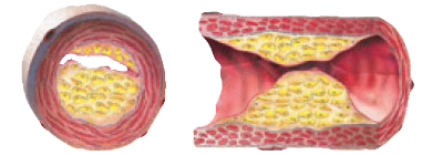 ANGINA PECTORIS  ISCHEMIA STROKE HEART ATTACK